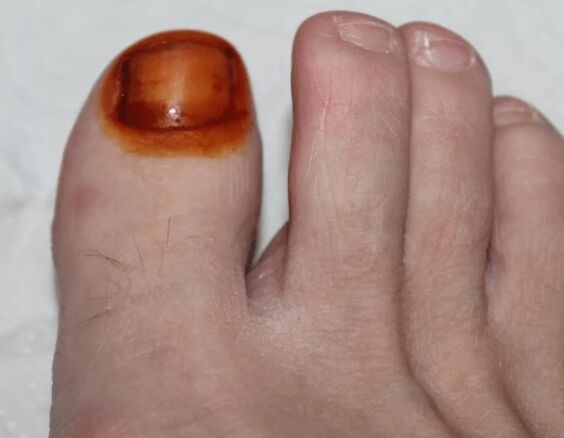 Tratamiento del yodo de hongo