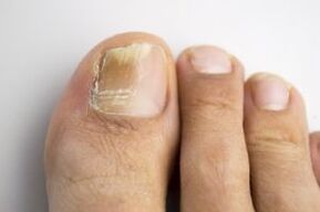 La enfermedad con un hongo