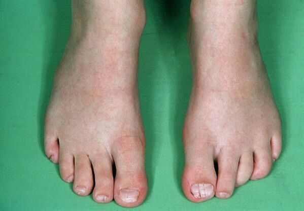 El hongo en las piernas