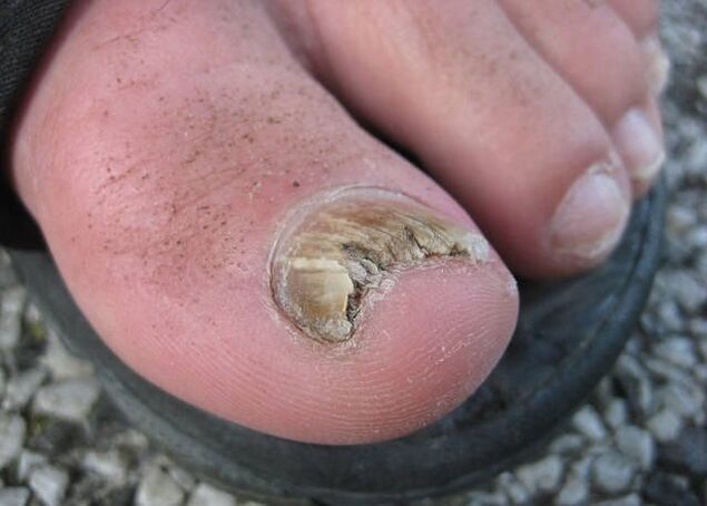 El resultado de la negligencia