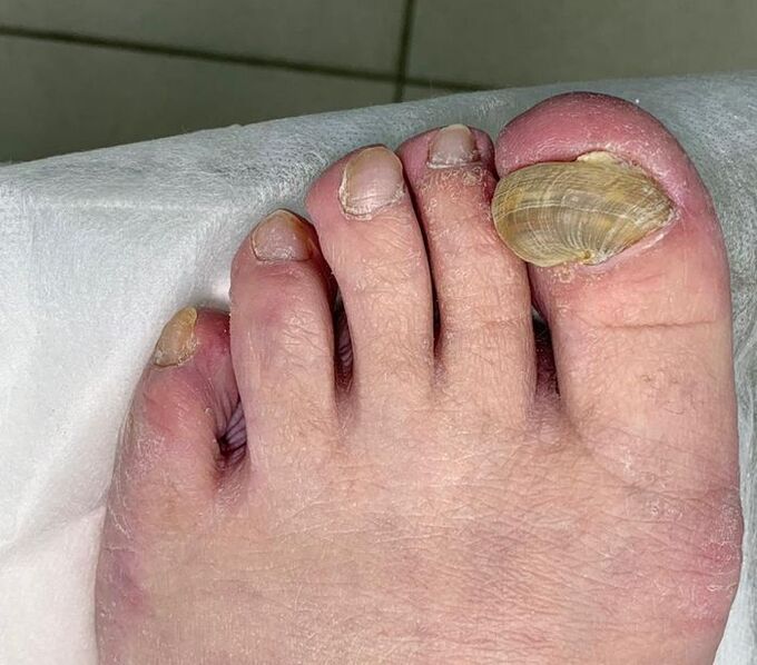 Onicomicosis hipertrófica en la pierna - uña deformada
