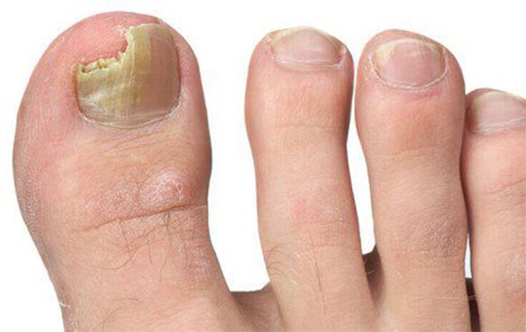 Varias formas de hongos