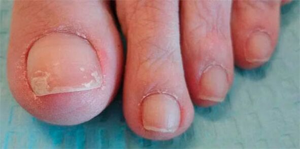 etapas de las piernas fúngicas