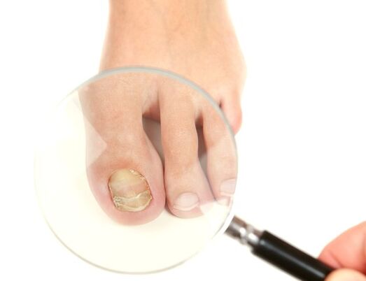 hongos en las uñas de los pies