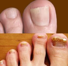 Etapas iniciales y avanzadas de hongos en los pies.