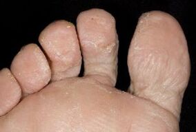 Síntomas de hongos en la piel de los pies.