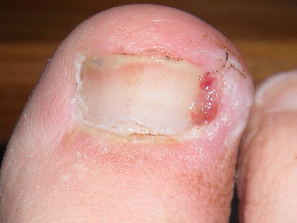 Uña encarnada como síntoma de una infección por hongos.
