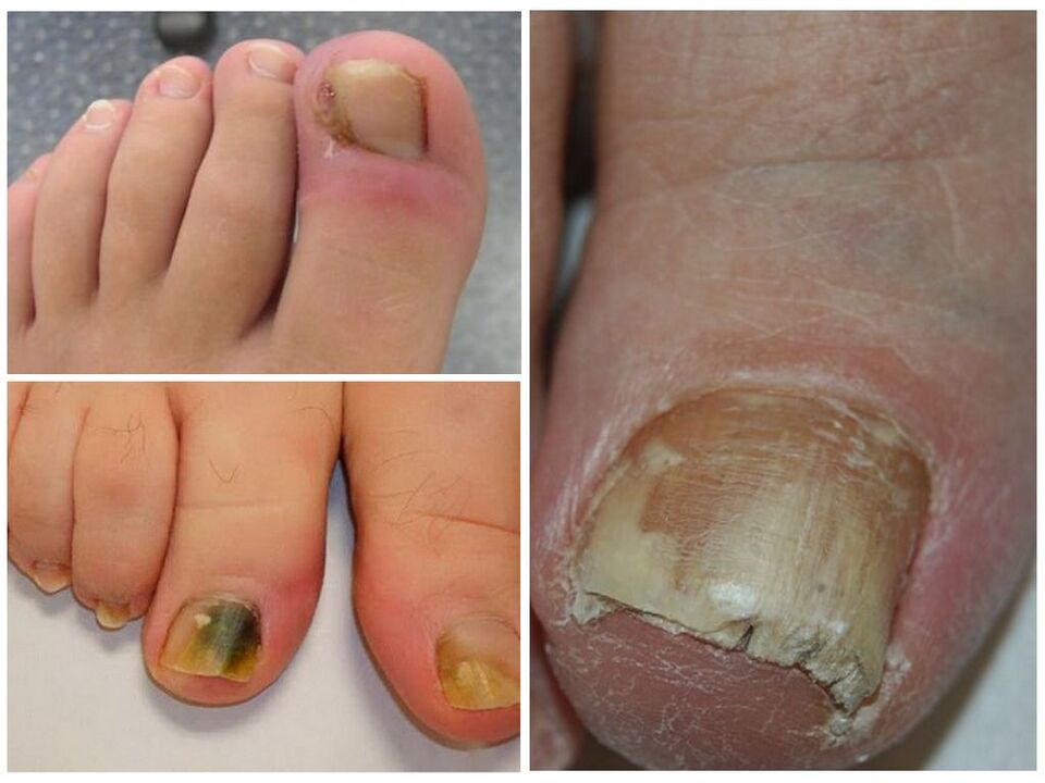 infección por hongos en las uñas de los pies