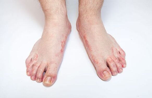 Enfermedad fúngica de la piel de los pies.