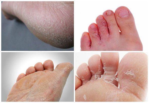 Las principales manifestaciones de la micosis de los pies son queratinización de la piel, grietas, descamación.