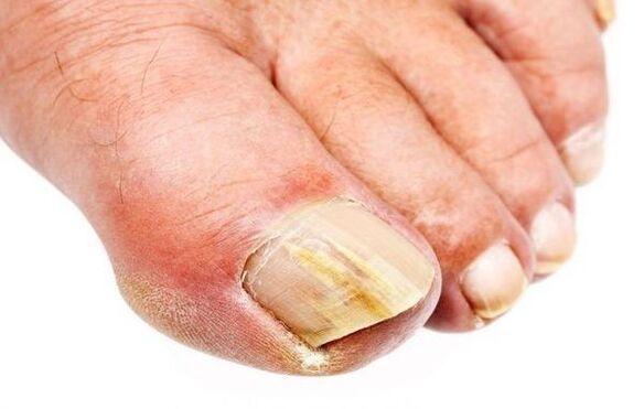 Onicomicosis - hongos en las uñas de los pies
