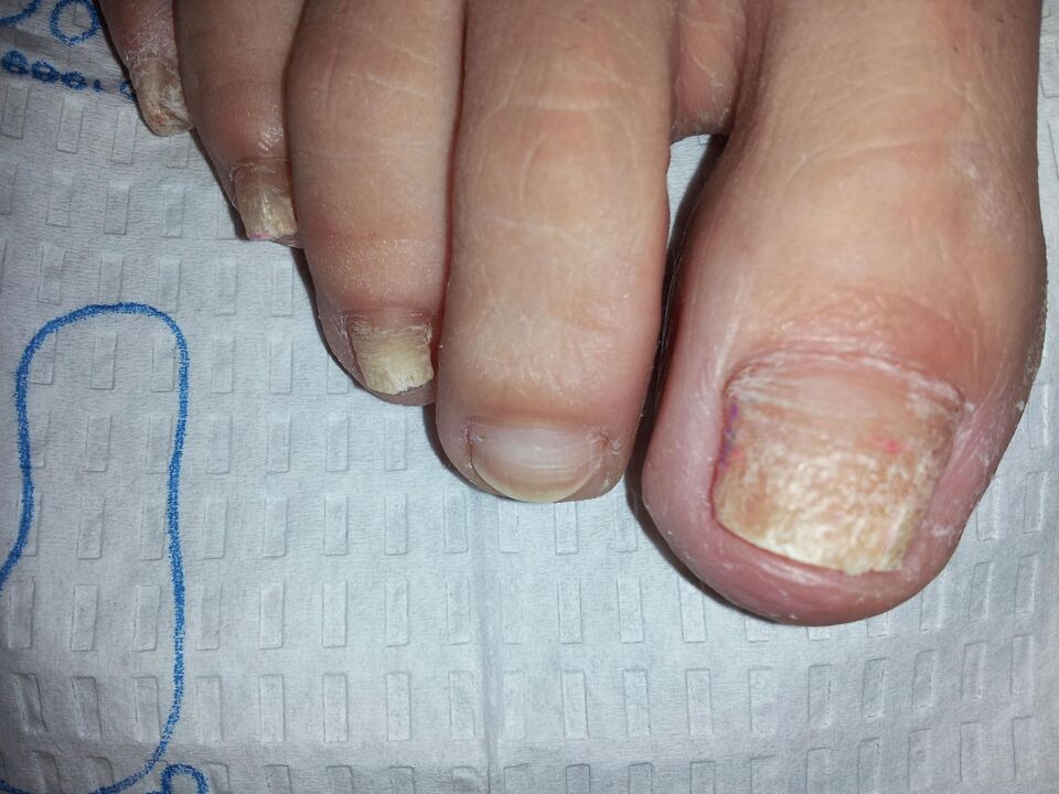 Cómo tratar los hongos en las uñas de los pies con celidonia.