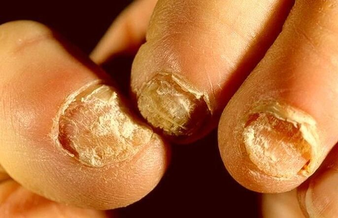 hongos en las uñas cómo tratar