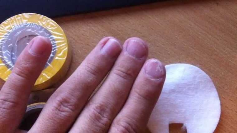 hongos en las uñas y su tratamiento con remedios caseros