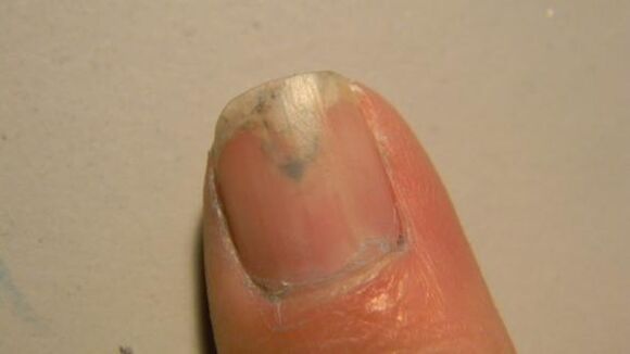 síntomas de hongos en las uñas