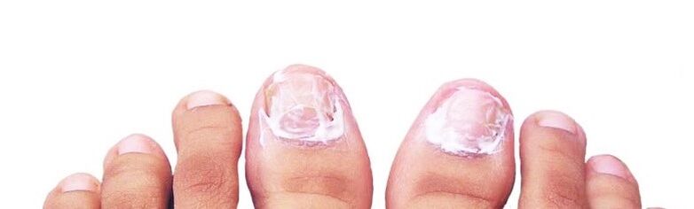 ungüento de uñas para hongos