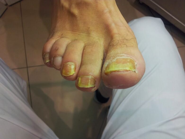 uñas de los pies amarillas debido a hongos