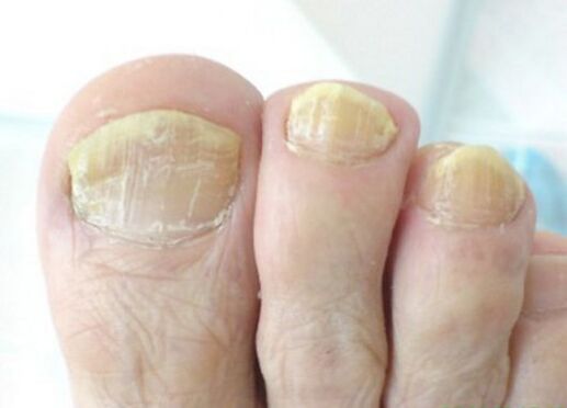 Hongos avanzados en las uñas de los pies.