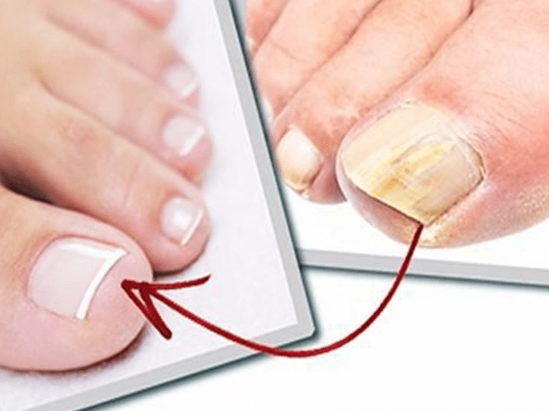Uñas de los pies afectadas por hongos y uñas sanas después del tratamiento casero.